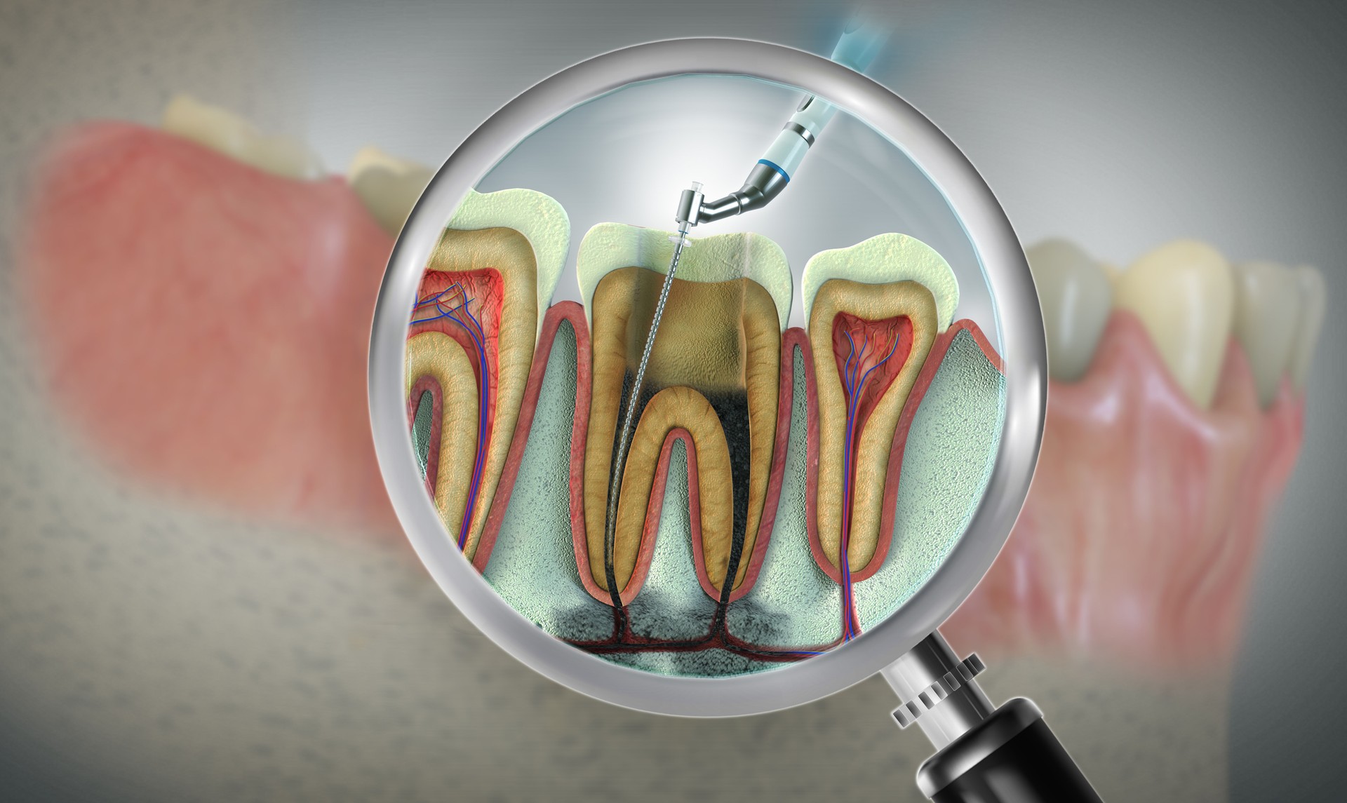 Endodontic root canal treatment. Medically approved 4D tooth illustration (Colour: Gray background)